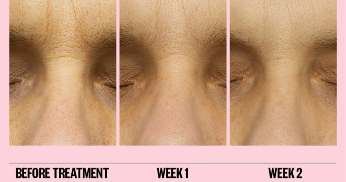 90% of Users Saw Improved Wrinkles Just 2 Hours After Using These Patches